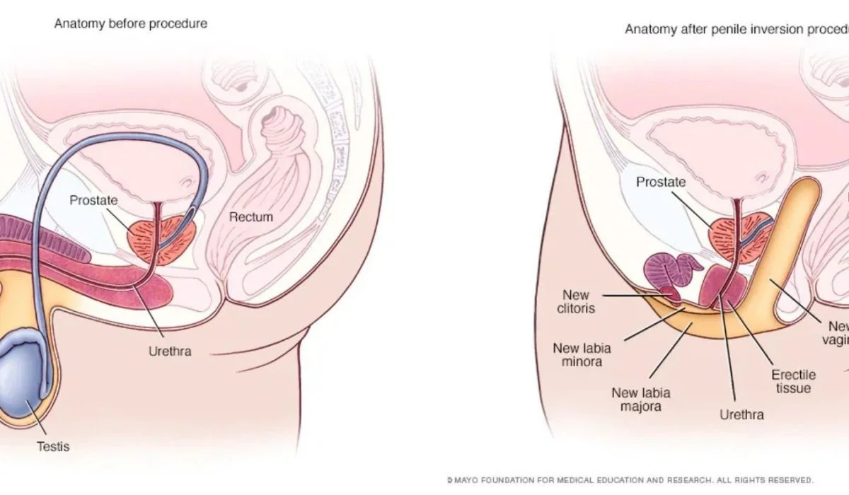 Penile Inversion Vaginoplasty.webp